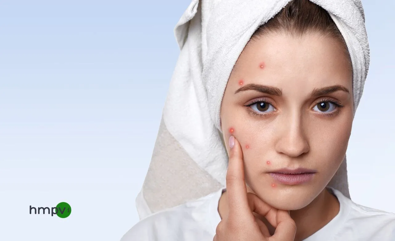 Acne Breakouts Causes, Prevention, and Best Treatments